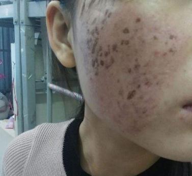 點(diǎn)陣式激光祛痘痘印出現(xiàn)多少次果?