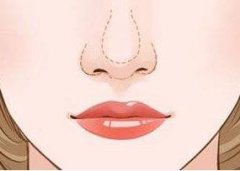 蒜頭鼻做鼻尖成形術(shù)改良果好嗎？美麗鼻子~