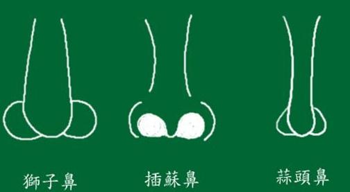 蒜頭鼻做鼻尖成形術(shù)改良果