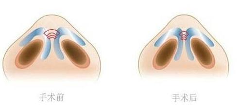 蒜頭鼻做鼻尖成形術(shù)的具體步驟如下