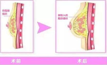 不體驗(yàn)注射式隆胸才不會(huì)知道豐胸原來(lái)如此簡(jiǎn)單