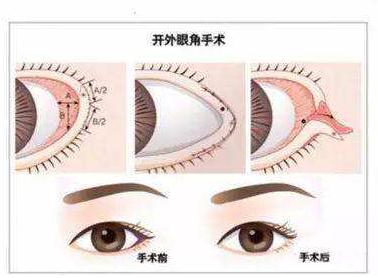 開內(nèi)眼角術后果如果不理想該怎么辦？