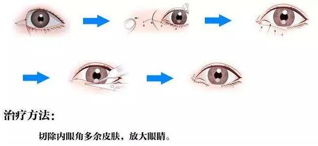 開內(nèi)眼角手術術后護理