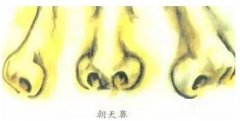 鼻孔外露手捏就能解決？還是手術(shù)比較靠譜！