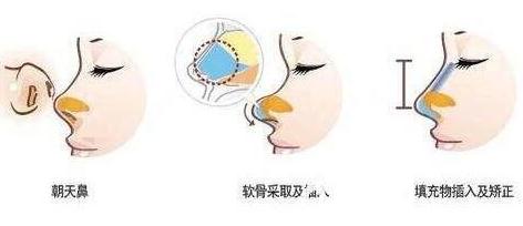 鼻孔外露手捏就能解決?