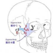 磨骨手術(shù)和顴骨內(nèi)推有什么區(qū)別？哪個(gè)風(fēng)險(xiǎn)大？