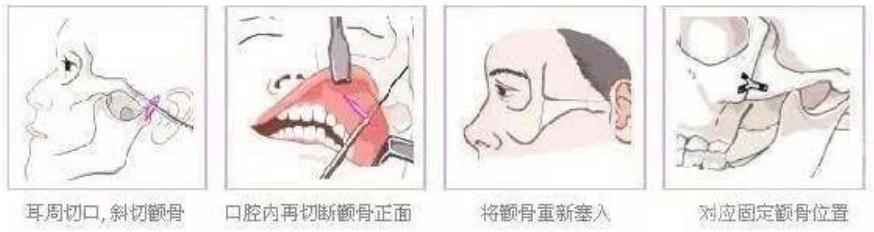 顴骨內(nèi)推和磨骨有什么區(qū)別？