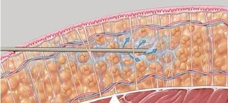 抽脂后不均勻主要與以下因素有關(guān)