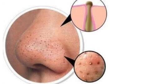 去除黑頭的小分子