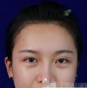聽說曹仁昌醫(yī)生技術(shù)很牛，找他做雙眼皮修復(fù)！
