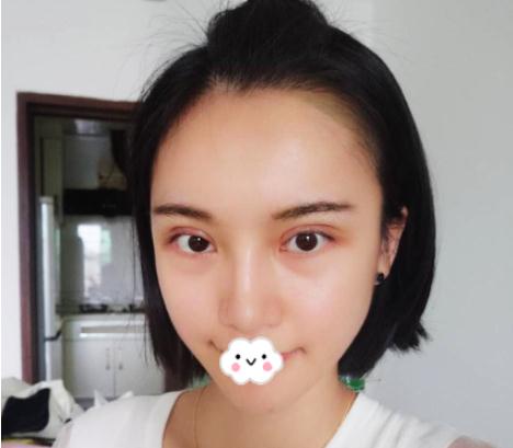 曹仁昌醫(yī)生做雙眼皮修復(fù)術(shù)后第8天