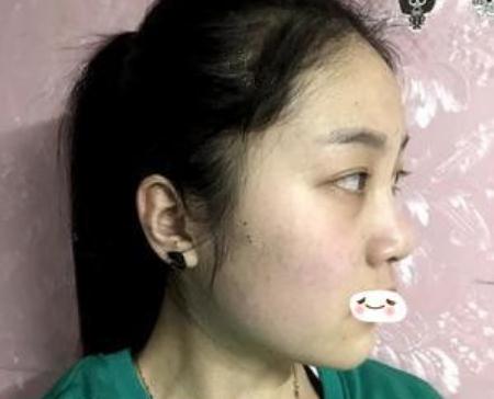 合肥維多利亞做鼻部手術(shù)手術(shù)術(shù)前