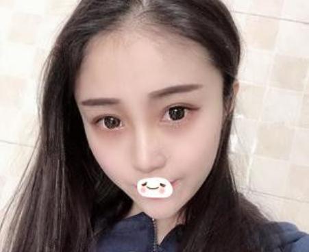 合肥維多利亞做鼻部手術(shù)手術(shù)術(shù)后一個月