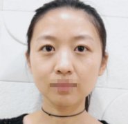 割雙眼皮7mm完成我想要大寬雙眼皮的夢想！