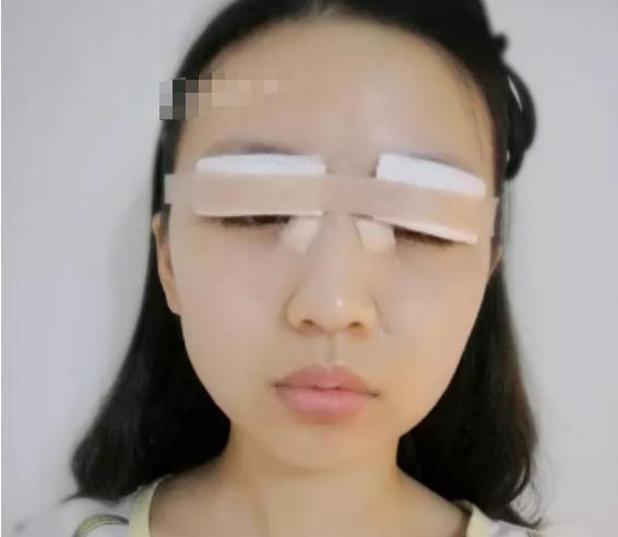 做雙眼皮手術(shù)術(shù)后