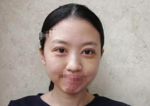 做雙眼皮手術(shù)術(shù)后第12天