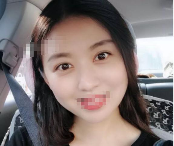 做雙眼皮手術(shù)術(shù)后第31天