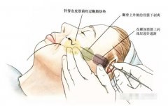 做全臉面部提升大概需要多少錢？怎么收費(fèi)的？
