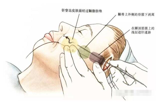 做全臉面部提升大概需要多少錢？怎么收費的？