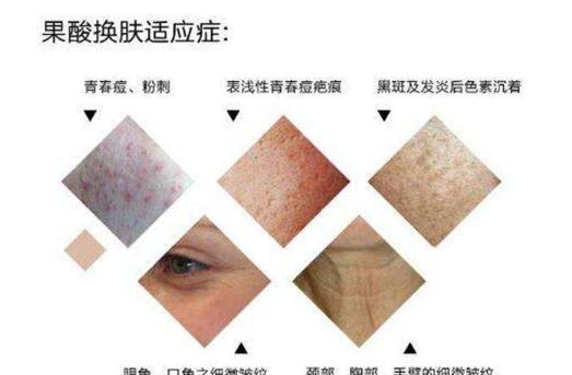 果酸換膚醫(yī)美項目原理