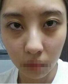 激光去黑眼圈有什么副作用?