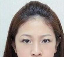 激光去黑眼圈有什么副作用?