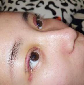 做完雙眼皮之后眼睛睜不開的措施