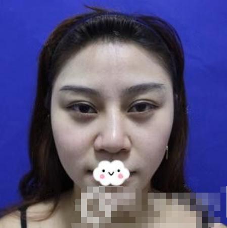 東莞韓美做的隆鼻修復手術術前