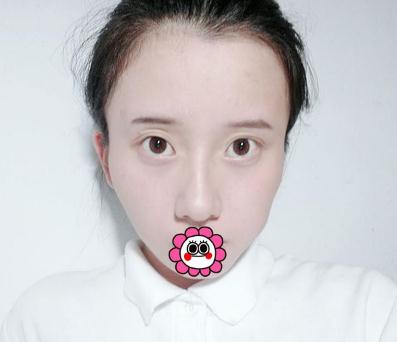 哈爾濱成美做了脂肪填充全臉手術(shù)術(shù)前