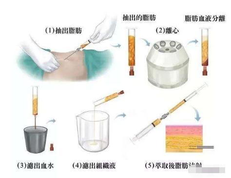 馮斌醫(yī)生對于自體脂肪技術(shù)的研究