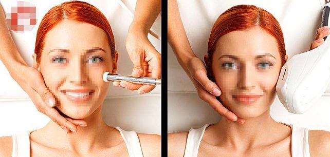 光子嫩膚能維持多久?