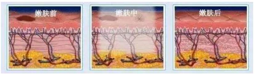 光子嫩膚多久做一次才好?