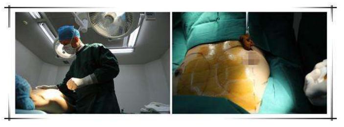 假體隆胸麥格和曼托哪個比較好?