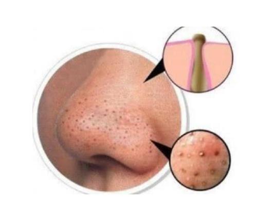 有黑頭應(yīng)該怎么辦？有的處理方法！