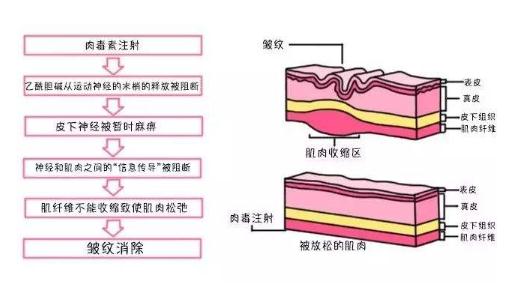 打去皺針幾天皺紋消失?