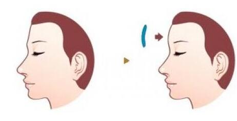 玻尿酸和自體脂肪更適合填補面部凹陷?