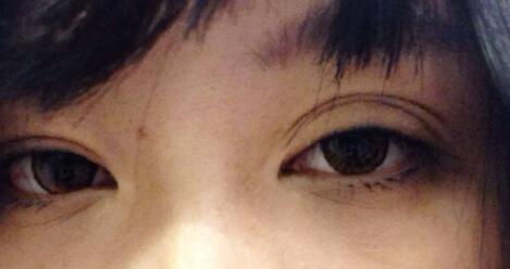 形成三個(gè)眼瞼