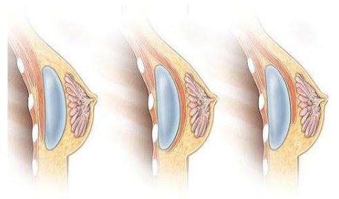 隆胸手術的切口都分為哪些？