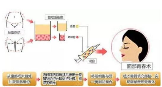 什么是自體脂肪面部填充？