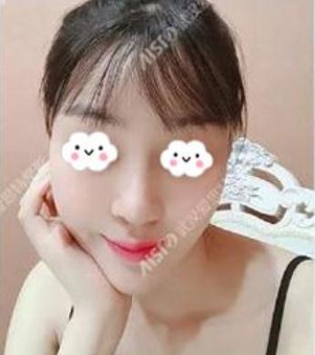 武漢愛(ài)思特做了硅膠隆鼻手術(shù)術(shù)后半年