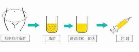 自體脂肪活細胞除皺術(shù)操作方式