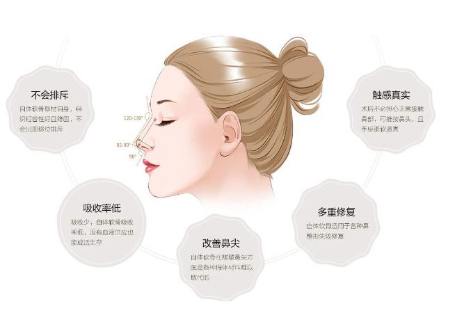 自體軟骨鼻成形術(shù)的缺點