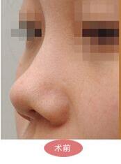 朝天鼻整容手術(shù)