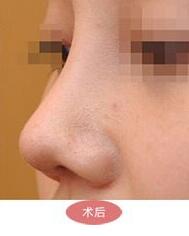 朝天鼻整容手術(shù)