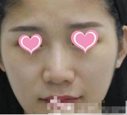 北京注射隆鼻手術(shù)術(shù)前