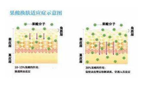 果酸換膚貴不貴?多少錢一次?