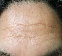 打了注射除皺能維持多久？