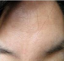 打了注射除皺能維持多久？