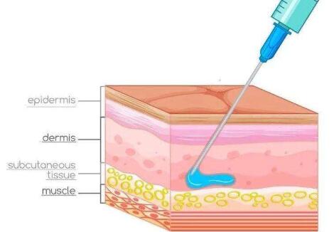 玻尿酸填充原理