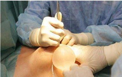 假體隆胸“麥格”與“曼托”，哪個的果好？